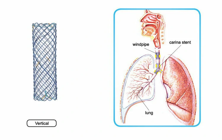 CITEC™ Tracheal Stent, Bronchial Stent, Airway Stent, Tracheal Stents, Bronchial Stents, Airway Stents, Airway stenting, Endoscopic stenting, It is used for tracheal stenosis caused by various malignant lesions