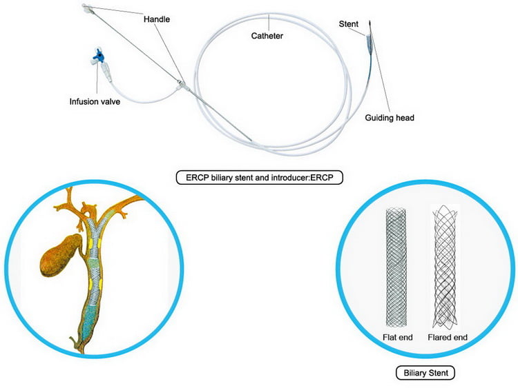 ercp stent