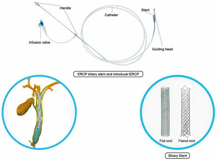 Biliary Stent, Biliary Stenting, PTCD, ERCP, Endoscopic stent