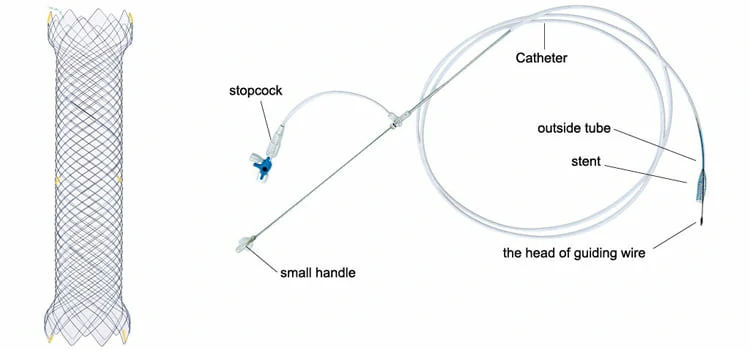 CITEC™ Duodenal Stent, Colonic  Stent, intestinal stents, Colonic Stenting, Endoscopic stent, Duodenal stenting, TTS, is used for for the intestinal (duodenal, colonic) stenosis, obstruction or anastomotic stenosis